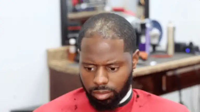 before bald hair kit
