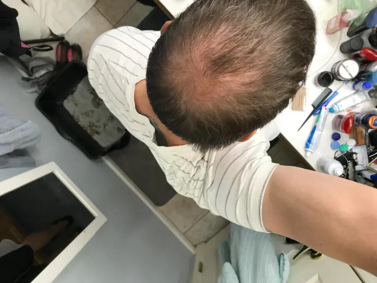 Before Bald Hair Kit